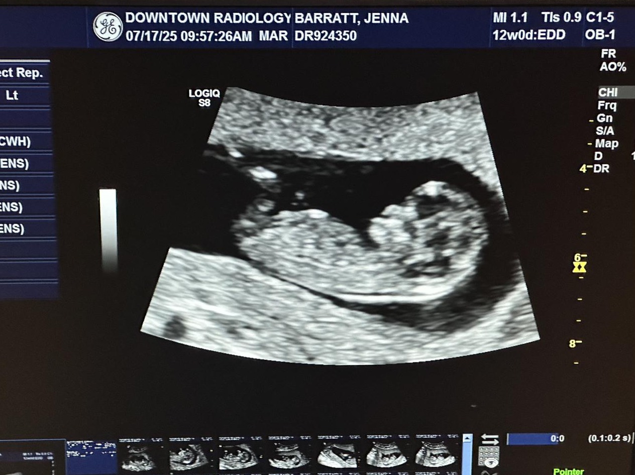 The first ultrasound